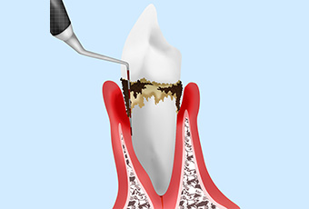 歯周ポケット検査