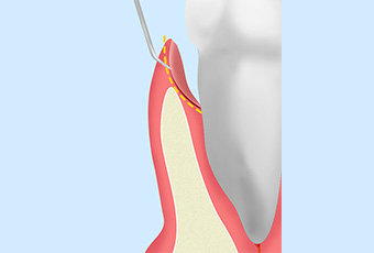 歯周ポケットそうは術
