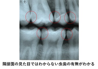 バイトウィング（咬翼法）