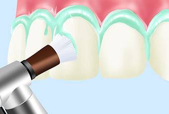 PMTC(歯のクリーニング)