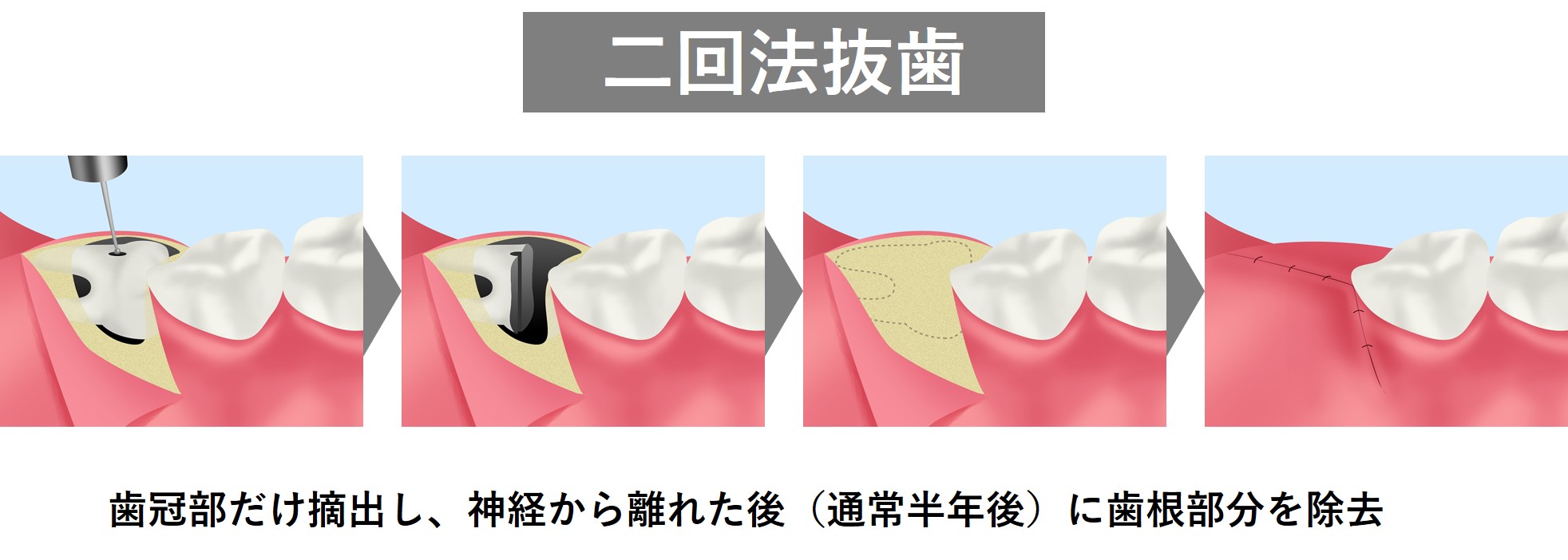 抜歯 費用 親知らず