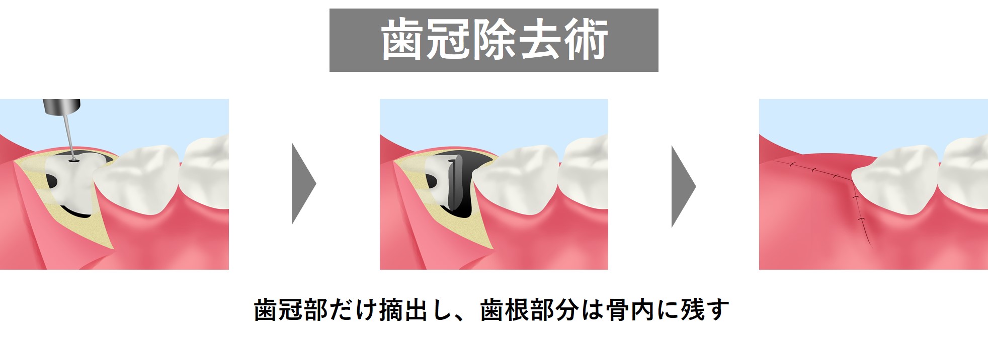 症例に応じて歯冠除去術を実施